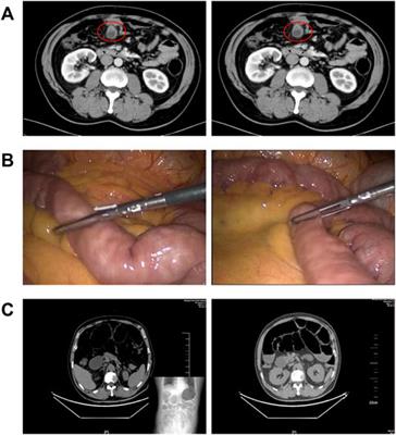 Molecular and cellular mechanisms underlying postoperative paralytic ileus by various immune cell types